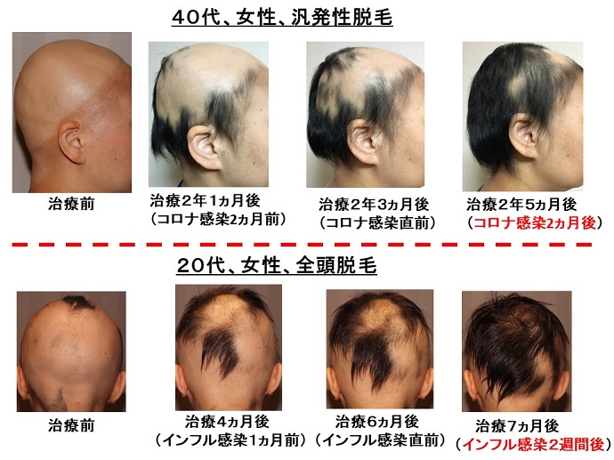 円形脱毛症　病院